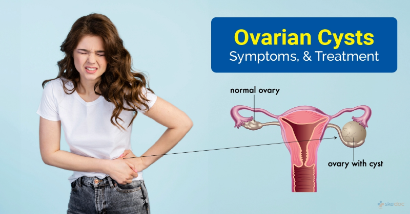 Medical illustration of a female uterus and ovaries, showing one normal ovary on one side and the other side with an enlarged ovary containing an ovarian cyst