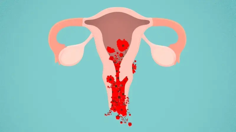 Medical illustration of a uterus showing abnormal uterine bleeding, highlighting the endometrial lining with visible blood flow to depict the condition