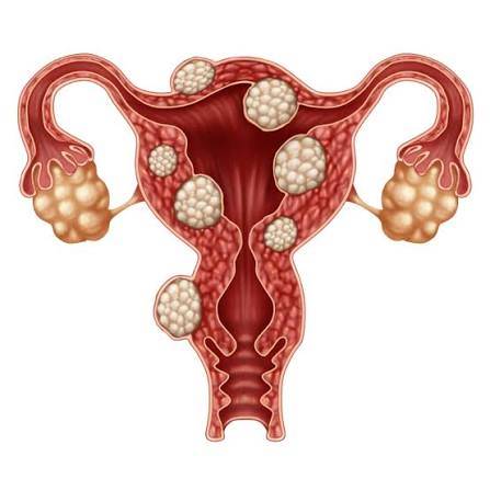 Do Fibroids Affect Fertility? When Do They Need to Be Removed?