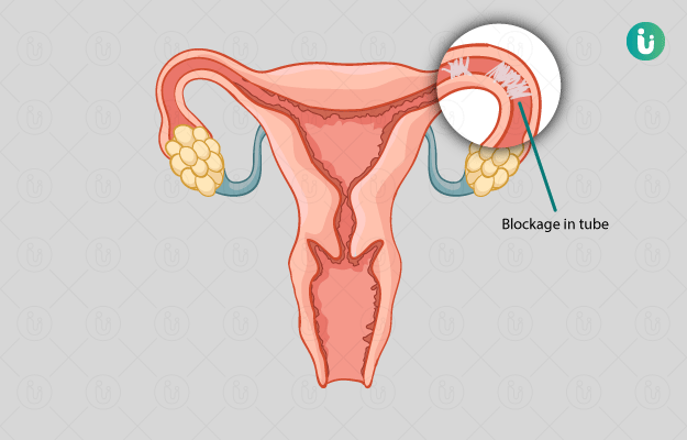 Medical illustration showing a blocked Fallopian tube, highlighting the obstruction that prevents the egg from traveling from the ovary to the uterus