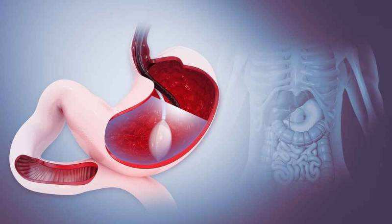 A journey to fitness: The gastric balloon — your guide to overcoming obesity