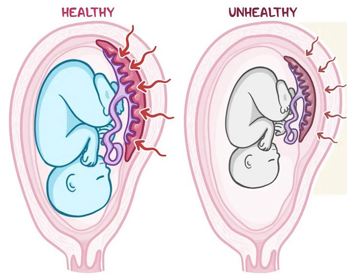 Side-by-side illustration showing a healthy fetus growing normally in the uterus next to a smaller fetus affected by fetal growth restriction, highlighting differences in size and development
