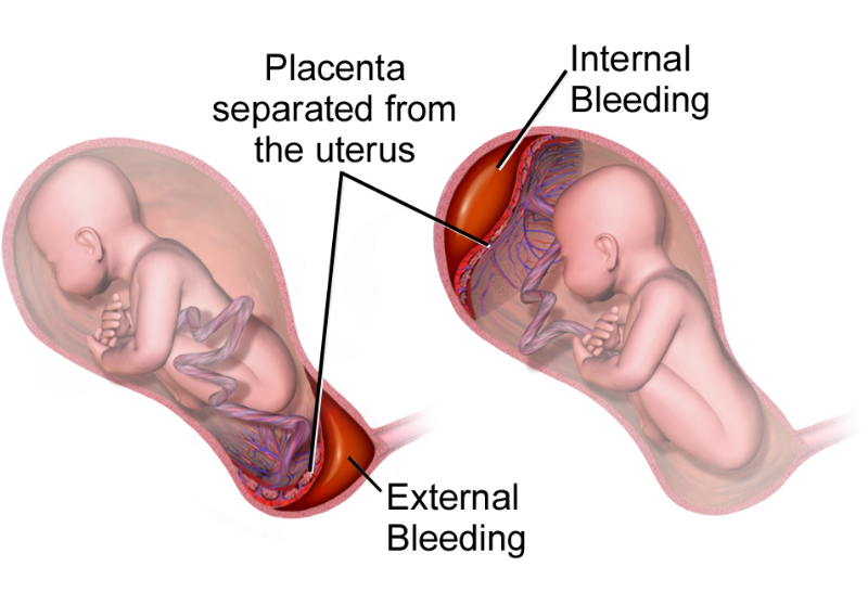Medical illustration showing placental abruption: the placenta partially detaching from the uterus, with one side showing internal bleeding and the other side showing external bleeding, both affecting the fetus in the womb