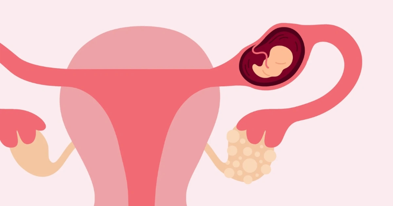 Medical illustration of a uterus showing an ectopic pregnancy, with a fertilized egg implanted in the fallopian tube instead of the uterine cavity