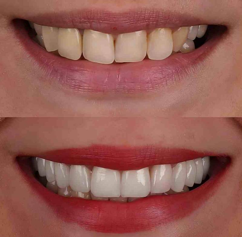 Before and after photo showing a noticeable transformation with Snap-On Smile — from uneven, stained teeth to a bright, perfectly aligned smile
