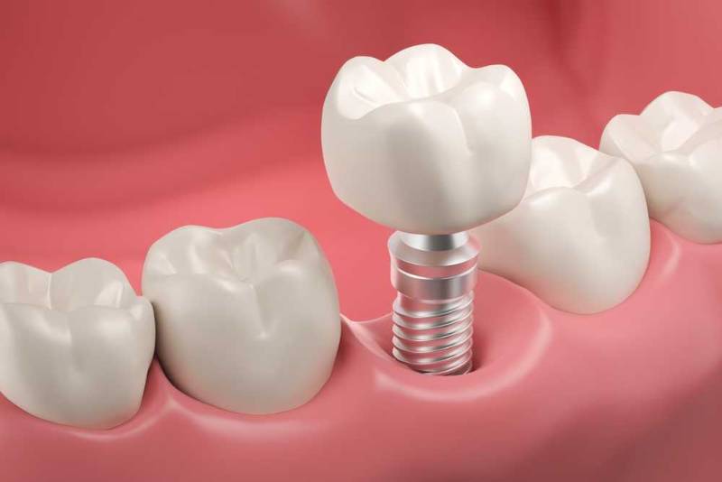 A close-up photo of a dental implant model showing the titanium screw inserted into the jawbone beneath a natural-looking artificial tooth, illustrating how dental implants work