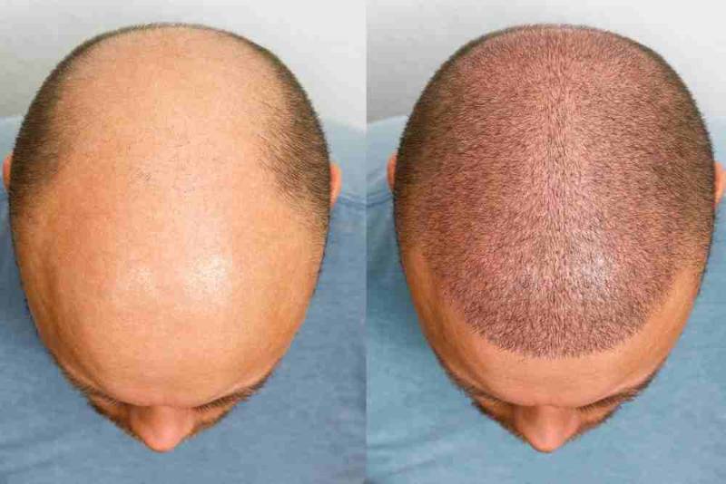 Before and after photo of a male patient showing visible improvement in hair density and hairline after a successful hair transplant procedure
