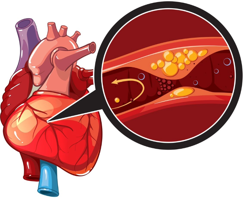 Medical illustration showing narrowed coronary arteries with reduced blood flow to the heart muscle, highlighting how coronary artery disease develops and can lead to a heart attack