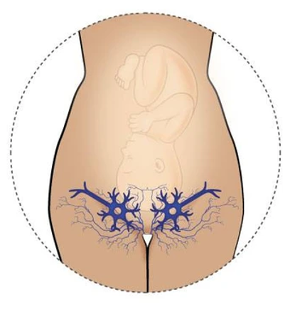 Close-up medical illustration showing the vaginal area with visible varicose veins on one side, highlighting swollen and enlarged veins causing discomfort