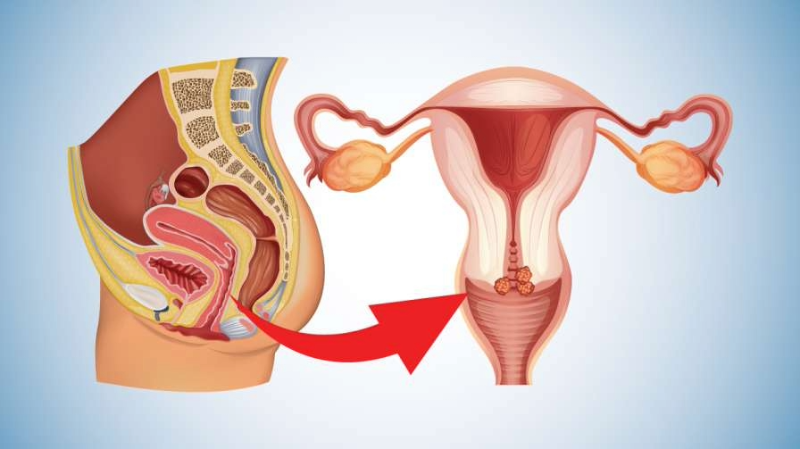 Illustration of female reproductive organs highlighting the cervix affected by cervical cancer