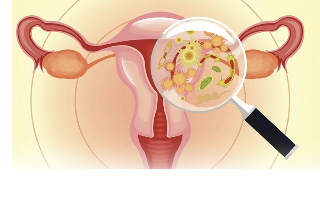 Medical diagram showing the vagina and uterus, highlighting common causes of vaginal infections such as bacteria, yeast, and sexually transmitted pathogens