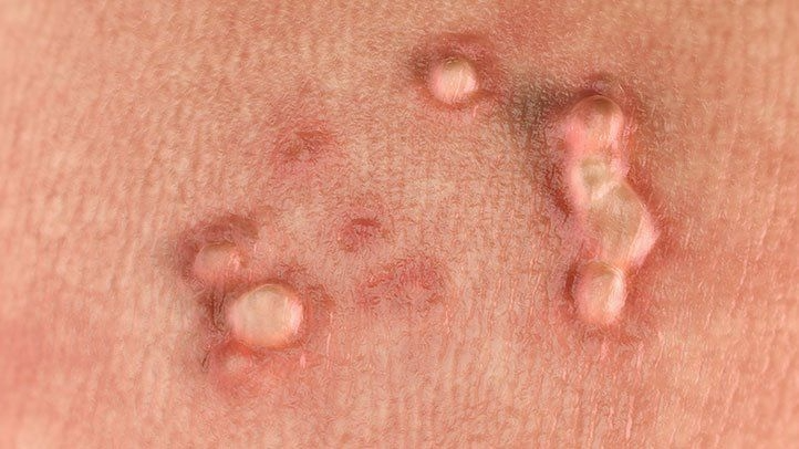 lose-up image showing small, raised, flesh-colored bumps typical of genital warts on the skin