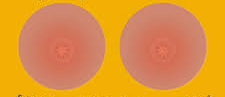 Close-up medical illustration of a female breast showing cracked and irritated nipples, with visible redness and small fissures to depict the condition